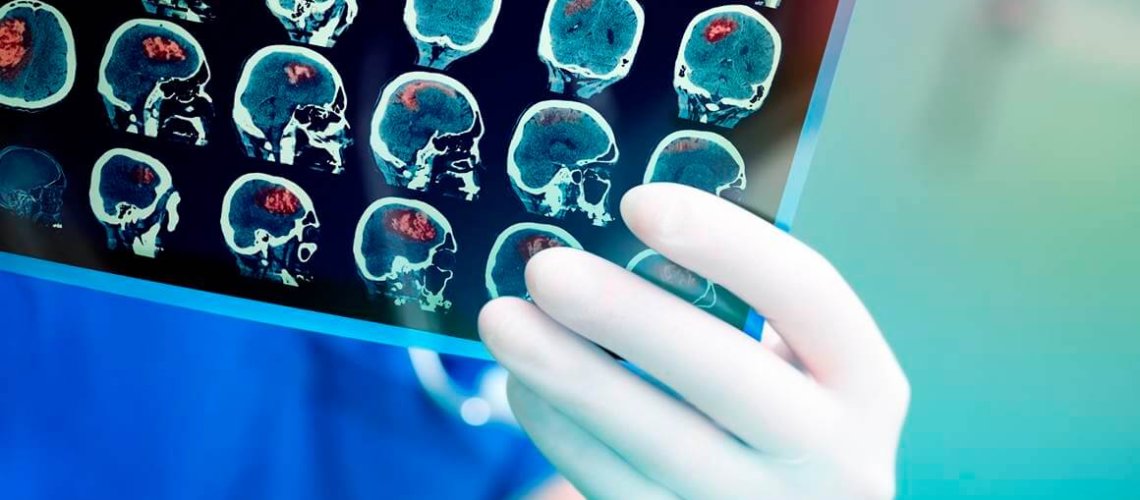 closeup-of-doctors-hand-holding-ct-brainscan.jpg