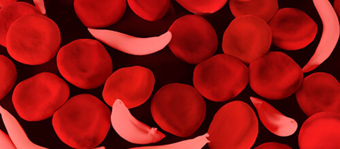 sicklecells.jpg
