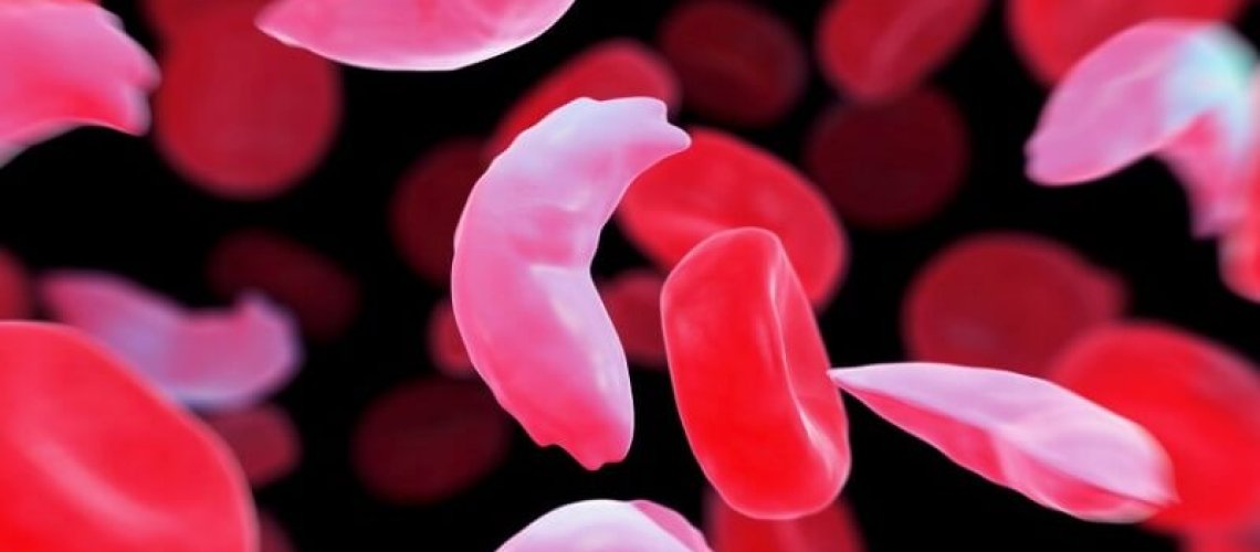 ui-health-validates-cure-for-sickle-cell-in-adults-healthinnovations.jpg